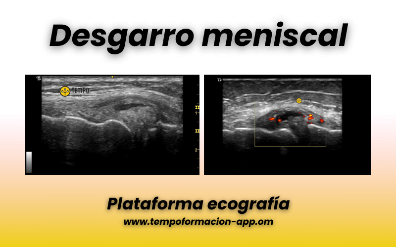 3. Menisco interno tempo formacion.png